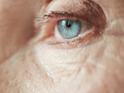 Cirurgia de catarata reduz a insônia. Pesquisa mostra que 36% das mulheres brasileiras tem insônia que melhora após cirurgia. Entenda