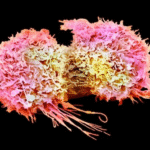 Como os tumores enganam o cérebro para que ele desligue as células de defesa contra o câncer. Cientistas descobrem e ficam mais próximos de descobriir a cura. Entenda com especialistas internacionais