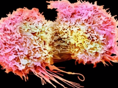 Como os tumores enganam o cérebro para que ele desligue as células de defesa contra o câncer. Cientistas descobrem e ficam mais próximos de descobriir a cura. Entenda com especialistas internacionais