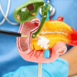 Médica diz o que colocar na dieta para evitar inflamação no pâncreas