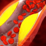 Cardiologista aponta que sinais o corpo dá quando as artérias estão com gordura; VEJA