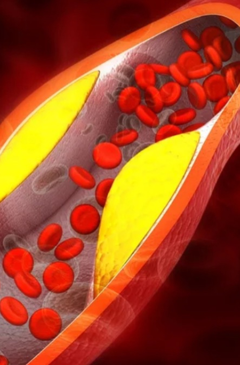 Cardiologista aponta que sinais o corpo dá quando as artérias estão com gordura; VEJA