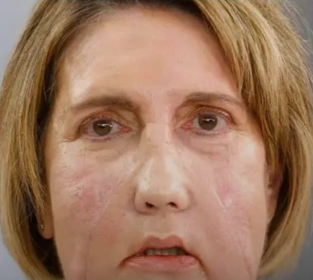 Hospital na Espanha realiza primeiro transplante de rosto do mundo com doadora que pediu eutanásia. Operação envolveu cerca de 100 profissionais de diferentes especialidades e salvou vida de outra mulher