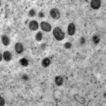 Porto Alegre confirma caso de Mpox e faz alerta no carnaval