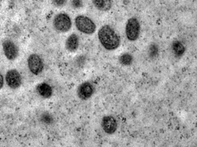 Porto Alegre confirma caso de Mpox e faz alerta no carnaval