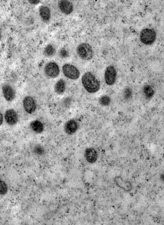 Porto Alegre confirma caso de Mpox e faz alerta no carnaval