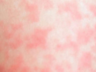 Verme ‘Altamente Contagioso’ Transmitido por Via Sexual Gera Alerta Internacional