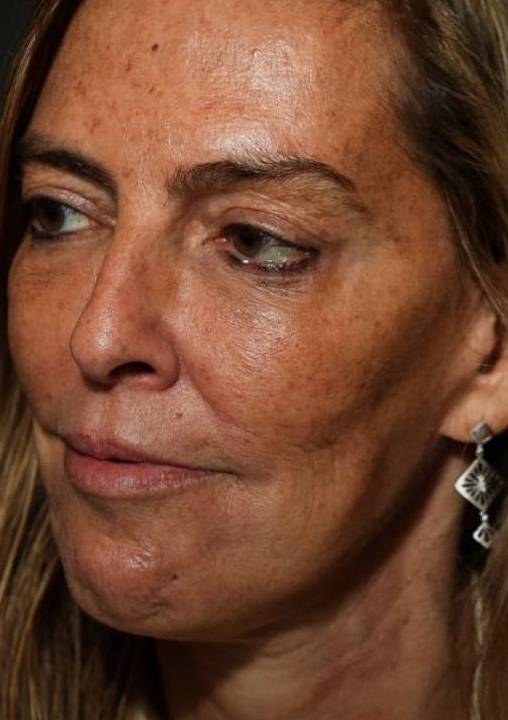 Brasil perdeu a patente internacional da Polilaminina apos cortes de recursos destinados a UFRJ no desgoverno Dilma do PT (que fez porto em Cuba, gastou milhões com artistas e carnaval). Veja vídeo de pesquisadora