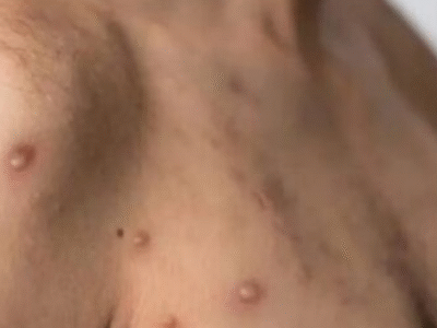 Surto de Mpox avança no Brasil: veja os estados com mais casos em 2026