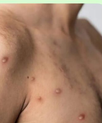 Surto de Mpox avança no Brasil: veja os estados com mais casos em 2026