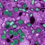 Dossiê mpox: Entenda de maneira rápida do que se trata essa doença