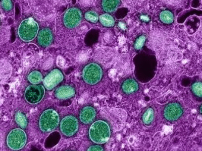 Dossiê mpox: Entenda de maneira rápida do que se trata essa doença