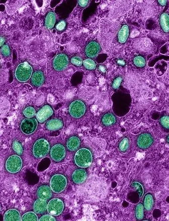 Dossiê mpox: Entenda de maneira rápida do que se trata essa doença