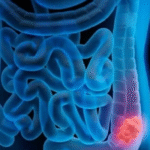 Conheça as causas que aumentam o risco de câncer colorretal