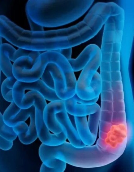Conheça as causas que aumentam o risco de câncer colorretal