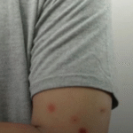 Vacina contra Mpox chega ao DF: Saiba quem pode se imunizar com as poucas doses