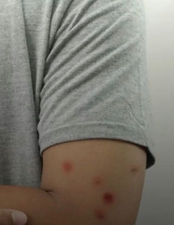 Vacina contra Mpox chega ao DF: Saiba quem pode se imunizar com as poucas doses