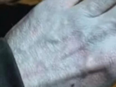 Homem vê partes do corpo azuladas, vai a hospital e se surpreende