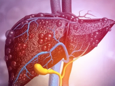 Os 5 sintomas de gordura no fígado que costumam não ser notados; VEJA QUAIS: