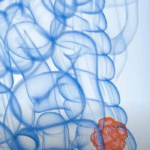 Câncer de intestino: os alimentos “inocentes” que podem estar destruindo seu corpo em silêncio e você precisa conhecer