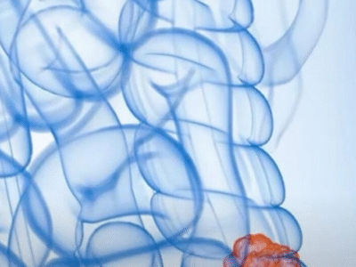 Câncer de intestino: os alimentos “inocentes” que podem estar destruindo seu corpo em silêncio e você precisa conhecer