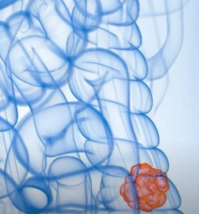 No momento, você está visualizando Câncer de intestino: os alimentos “inocentes” que podem estar destruindo seu corpo em silêncio e você precisa conhecer