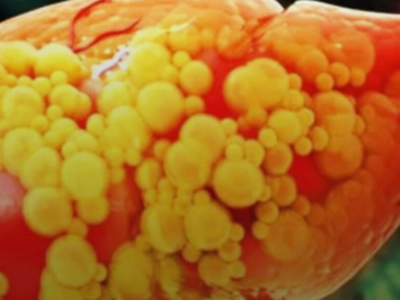 Essa caneta emagrecedora reduz em até 60% a gordura do fígado, afirma estudo