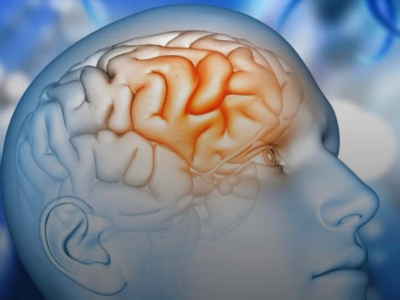 Esse novo medicamento contra Alzheimer pode reduzir declínio cognitivo em até 50%, VEJA