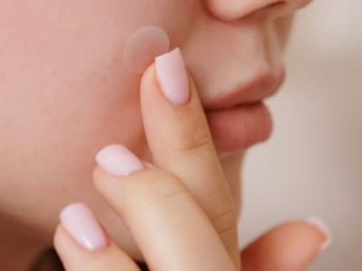 Adesivo para espinha funciona? Saiba quando vale a pena usar os patches de hidrocoloide. Saiba para quais casos podem funcionar e substituir o tratamento da acne