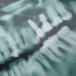 USP desenvolve IA que ajuda dentistas a detectar cáries em radiografias
