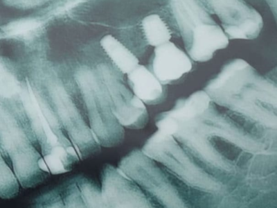 USP desenvolve IA que ajuda dentistas a detectar cáries em radiografias