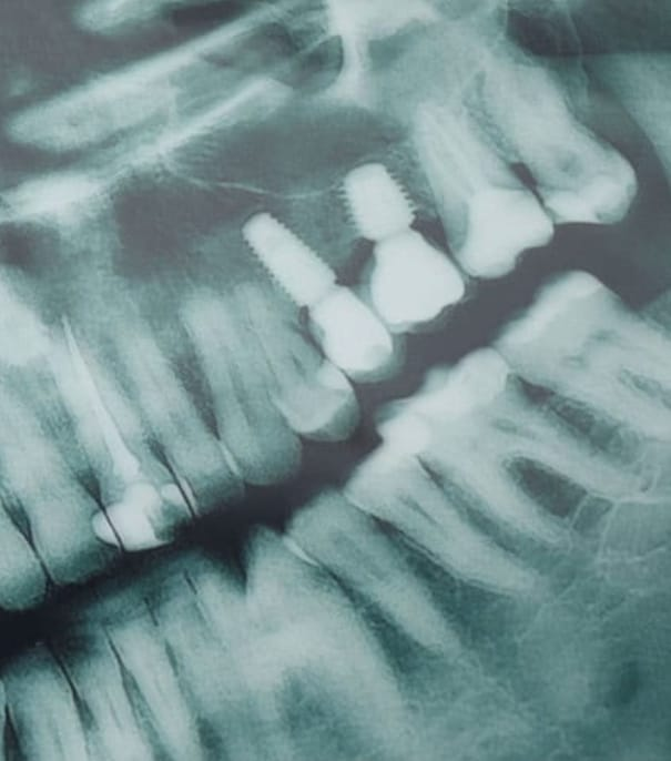 No momento, você está visualizando USP desenvolve IA que ajuda dentistas a detectar cáries em radiografias