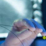 Nova técnica pode desobstruir artérias calcificadas sem uso de stent. Combinação de litotripsia intravascular e balão farmacológico apresentou resultados promissores