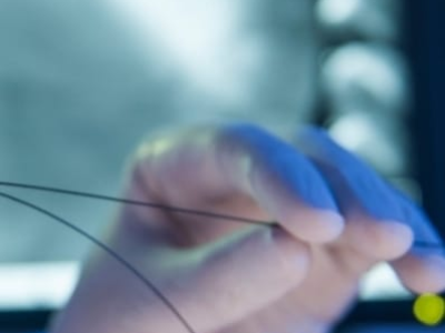 Nova técnica pode desobstruir artérias calcificadas sem uso de stent. Combinação de litotripsia intravascular e balão farmacológico apresentou resultados promissores