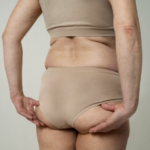 Bumbum sanfona”: recuperar 8o peso devolve o mesmo contorno dos glúteos? Antes de pensar em harmonização, preciso avaliar o que mudou no volume, na musculatura e na pele”, afirma o médico Chris Lima