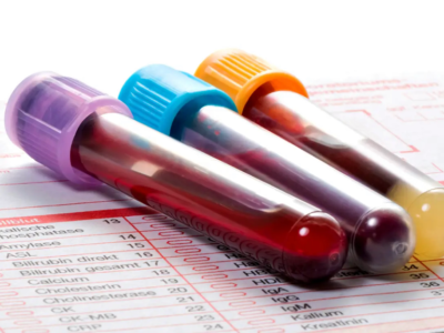 Novo exame de sangue para Alzheimer: Saiba quem precisa fazer