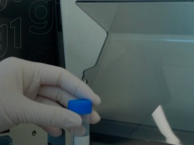 Exame de sangue para Alzheimer acaba de chegar ao Brasil; saiba quanto custa e o que o exame revela